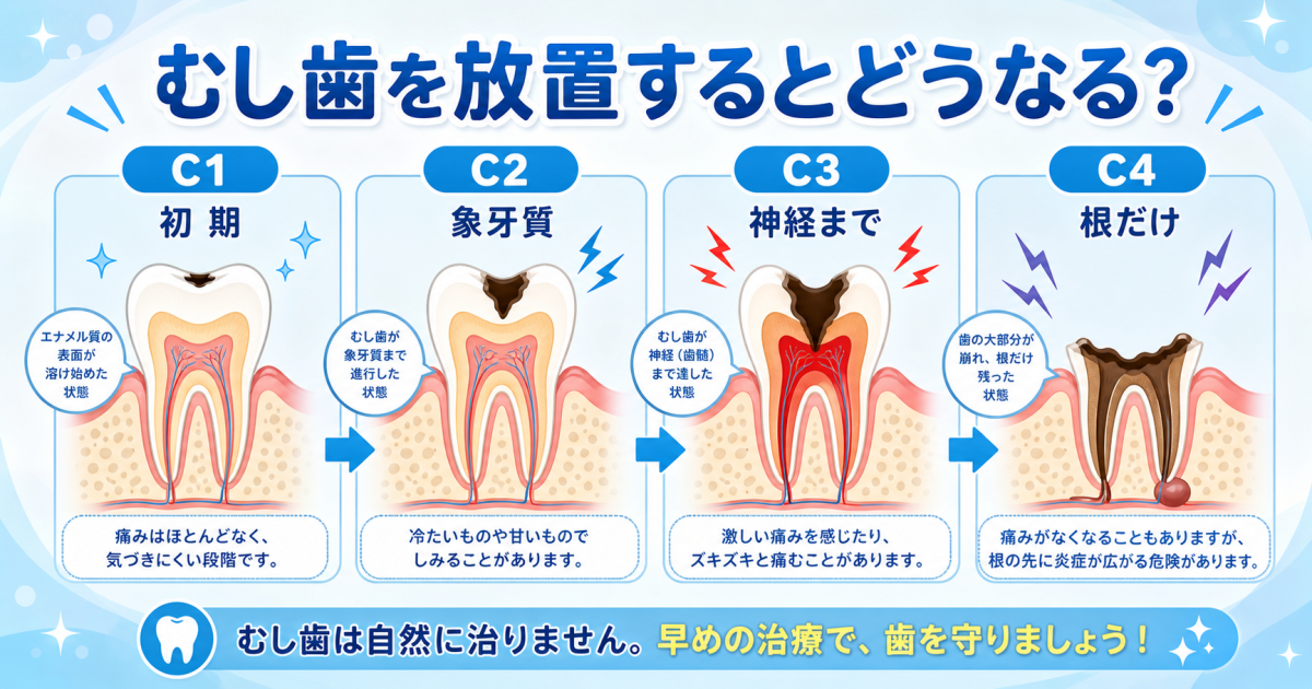 むし歯を放置するとどうなる？ズキッとする痛みの悪化と3つの対処法