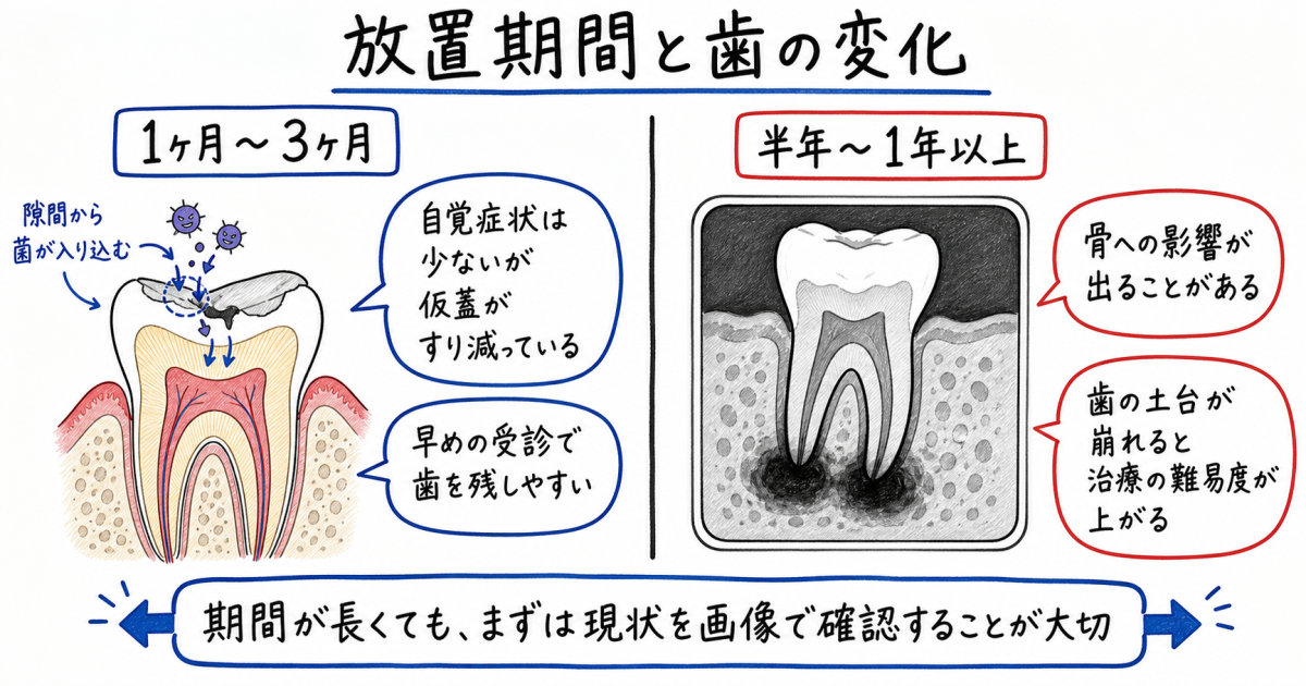 放置期間（1ヶ月・半年・1年以上）による歯のダメージと変化