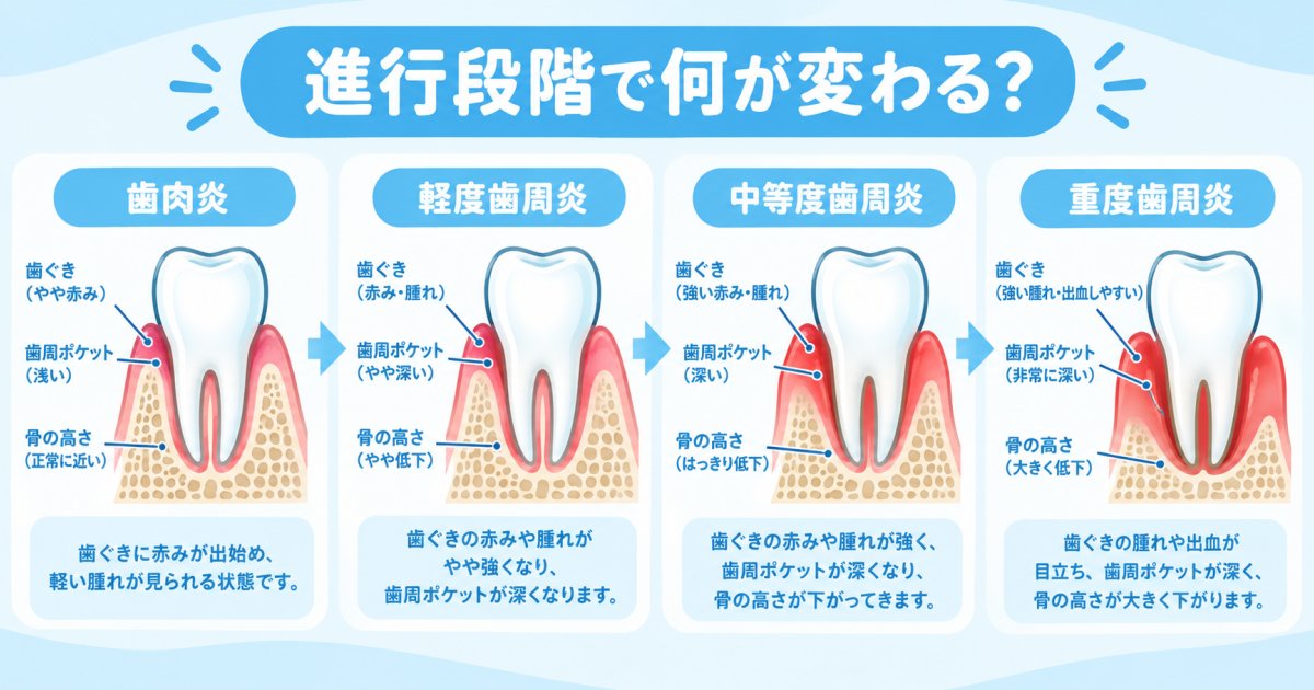 歯肉炎から歯周炎へ、進行段階で何が変わる？