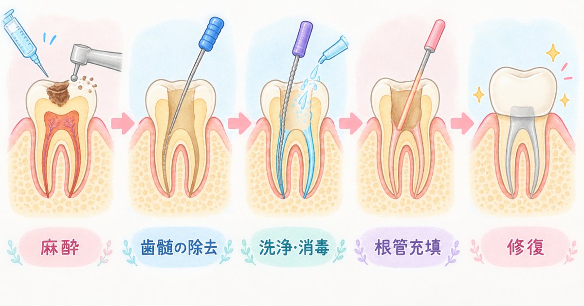 歯の神経の治療は、根の中を清掃してふさぐ処置